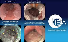 Image result for esophagus