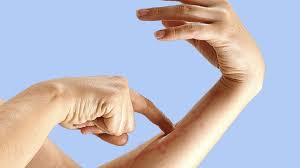 Jan 19, 2021 · to be diagnosed with sepsis, you must have a probable or confirmed infection and all of the following signs: Roter Strich Am Arm Ein Zeichen Fur Blutvergiftung