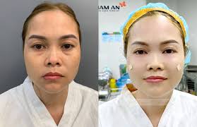 CẦN LƯU Ý KHI CẤY MỠ TỰ THÂN