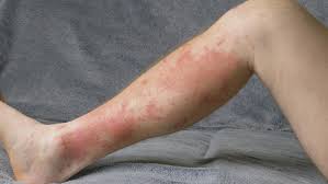 Image result for allergy rash on the legs