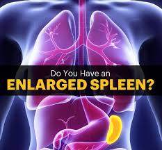 The word spleen comes from ancient greek σπλήν (splḗn). Behandlungen Haben Vergro Warnzeichen Warnzeichen Vergrosserte Milz Behandlung