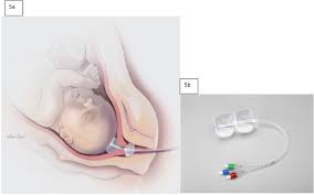 Image result for Labor Induction