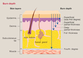 This can be illustrated in figure 3. Management Of Burns Surgery Oxford International Edition