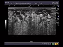 An ultrasound should not replace an annual mammogram when checking for breast cancer, but it does offer an additional tool. A Gallery Of High Resolution Ultrasound Color Doppler 3d Images Breast