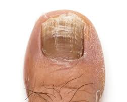 Image result for Onychogryphosis feet