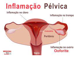 Inflamacao Dos Ovarios Ooforite Medicina Mitos E Verdades