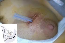 Entzundliche Erkrankungen Der Weiblichen Brust Springerlink