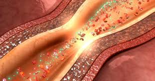 Coronary Artery Spasm Causes Symptoms And Prognosis