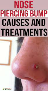 Nose Piercing Bump Causes And Treatments Nose Piercing Bump Piercing Bump Nose Piercing