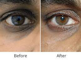 Laser Treatment For Dark Circles Cost In Bangalore