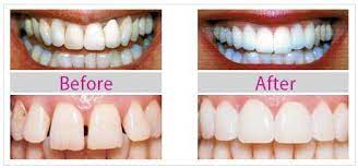 Pin On Dental Implants Clinic In South Delhi