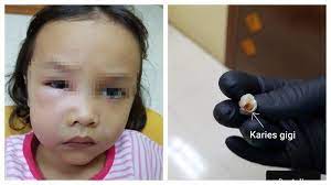 Anda terhubung dengan distributor terpercaya dan resmi dari terbaik dari korea joypolinse propolis mouthwash yang sedang trending karena khasitnya yang luar. Gigi Berlubang Bocah 5 Tahun Hampir Tewas Dokter Sebut Dampak Makanan Manis Konsumsi Obat Tribunnews Com Mobile