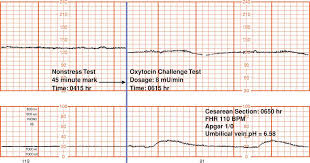 Image result for Contraction Stress Test