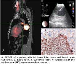 Looking for online definition of tbna or what tbna stands for? P2 21 Endobronchial Ultrasound Transbronchial Needle Aspiration Ebus Tbna Experience In A Reference Hospital In Latin America Journal Of Thoracic Oncology