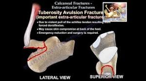 Image result for Calcaneus Compression Fracture