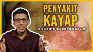 Antara salah sayu jenis kayap yang seringkali dikaitkan dnegan mitos boleh membawa maut adalah kayap ular. Betul Ke Kayap Ular Boleh Membawa Maut Penyakit Kayap Penyebab Simptom Komplikasi Dan Rawatan Youtube