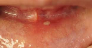 Baking soda and peroxide baking soda and hydrogen peroxide is a classic home remedy for whitening teeth. White Spots And Sores On Gums Causes Treatment And Symptoms