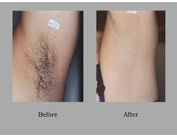 See reviews, photos, directions, phone numbers and more for the best hair removal in tacoma, wa. Laser Aesthetics Hawaii