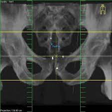 As part of the preparation for radiotherapy to the prostate, your oncology doctor has recommended that you have gold markers implanted into the prostate gland. Visualization Of Three Gold Markers Implanted Into The Prostate On A Download Scientific Diagram