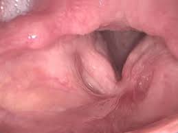 For example, biopsy samples may. Throat Cancer Causes Signs Symptoms Survival Rate Treatment