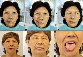 Bell's palsy is not triggered by a stroke, but it can cause identical symptoms. Bell Palsy A Clinical Diagnosis With A Management Challenge