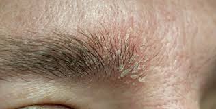 Image result for Dry Skin