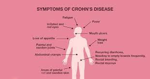 Crohn S Disease A Common Life Threatening Illness Sambav Blog