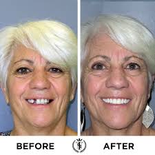 Cheryl came to us for a second opinion after she visited another facility.  She had broken and missing teeth and difficulty chewing. With New Teeth  Now, she had a full set of