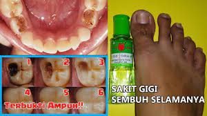 Pada kasus sakit gigi berlubang, pijat sakit gigi ini akan lebih cepat menyembuhkan jika dikombinasikan dengan obat sakit gigi berlubang. Sakit Gigi Sembuh Dalam 10 Menit Dengan Cara Ajaib Tak Terduga Ini Youtube