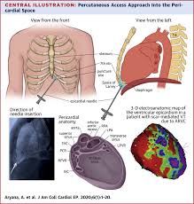 Of the first three ribs at the top of your rib cage could rupture . Percutaneous Epicardial Approach To Catheter Ablation Of Cardiac Arrhythmias Sciencedirect