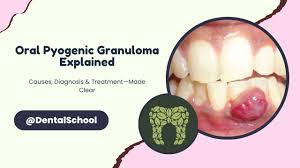 Image result for granuloma gum disease
