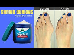 How To Get Rid Of Bunions Naturally On Pinky Toe Without Surgery Home Remedies To To Shrink Bunion Youtube Bunion Remedies Get Rid Of Bunions Feet Care