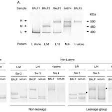 Sand und zement reagieren jedoch in gewissem rahmen mit natrium, was die löschwirkung mindert. Pdf Effects Of Molecular Structural Variants On Serum Krebs Von Den Lungen 6 Levels In Sarcoidosis