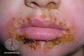 Image result for yellow scabs on the face in children