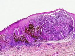 When this cancer becomes invasive or spreads beyond the original site, the disease is known as lentigo maligna melanoma. Pictures Of Nodular Melanoma