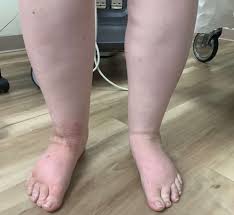 To avoid swollen feet, flex your ankles by turning them slowly every 10 times every hour. Ankle Swelling Treatment Causes Ankle Swelling Diagnosis Center