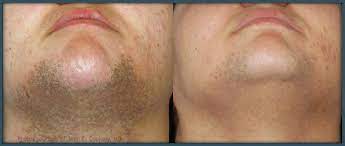 It primarily happens with beard in the chin, cheeks, and even neck. Remove Body And Facial Hair San Francisco Ca Aesthetic Surgery Center