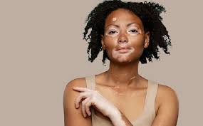 Image result for Vitiligo