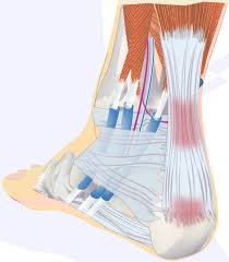 Presence of a bone spur (insertional tendonitis). Achilles Tendonitis Causes Symptoms Treatment