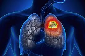 About 235,760 new cases of lung cancer (119,100 in men and 116,660 in women) about 131,880 deaths from lung cancer (69,410 in men and 62,470 in women) lung cancer mainly occurs in older people. Lung Cancer Is On The Rise For Women
