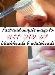 home remes to get rid of blackhead