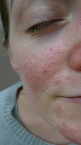 Acd A Z Of Skin Rosacea