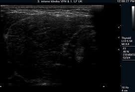 This test may be combined with a radioactive iodine scan to show a visual image of the uptake pattern. The Role Of Ultrasound In The Differential Diagnosis Of Hypothyroidism Intechopen