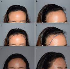 Laser hair removal was the 4th most popular cosmetic treatment in 2012! Figure 3 Secondary Revision Of Female Hairline Correction Surgery Personal Experience Springerlink