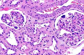 Department of health and human services food and drug. Acute Renal Failure Arf Acute Kidney Failure Online Medical Library