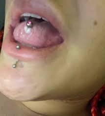Strange White Lump Tongue Piercing Glow Community