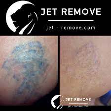 Using the tattoo gun to inject the removal solution into the skin. Tattoo Remover Jet Remove Permanent Makeup And Tattoo Removal