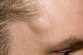 I have a painful lump in my left shoulder blade. Lipoma Nhs