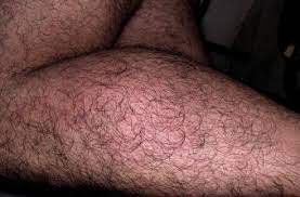 The virus most probably entered through the genitals. Chronic Urticaria Associated With Recurrent Genital Herpes Simplex Infection And Success Of Antiviral Therapy A Report Of Two Cases Sciencedirect