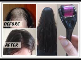 This reduces the likelihood that the roller will catch and pull the hair. Derma Roller System Review Buy Beauty Skin Products Regrow Hair Baldness Cure Help Hair Loss